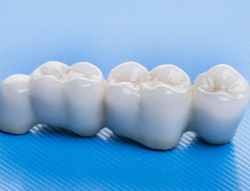 Dental Bridges: Restoring Missing Teeth with Functional Stability