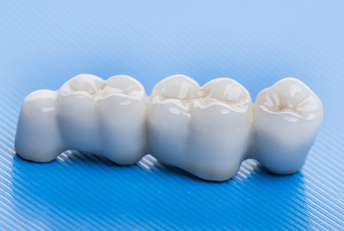 Dental Bridges: Restoring Missing Teeth with Functional Stability