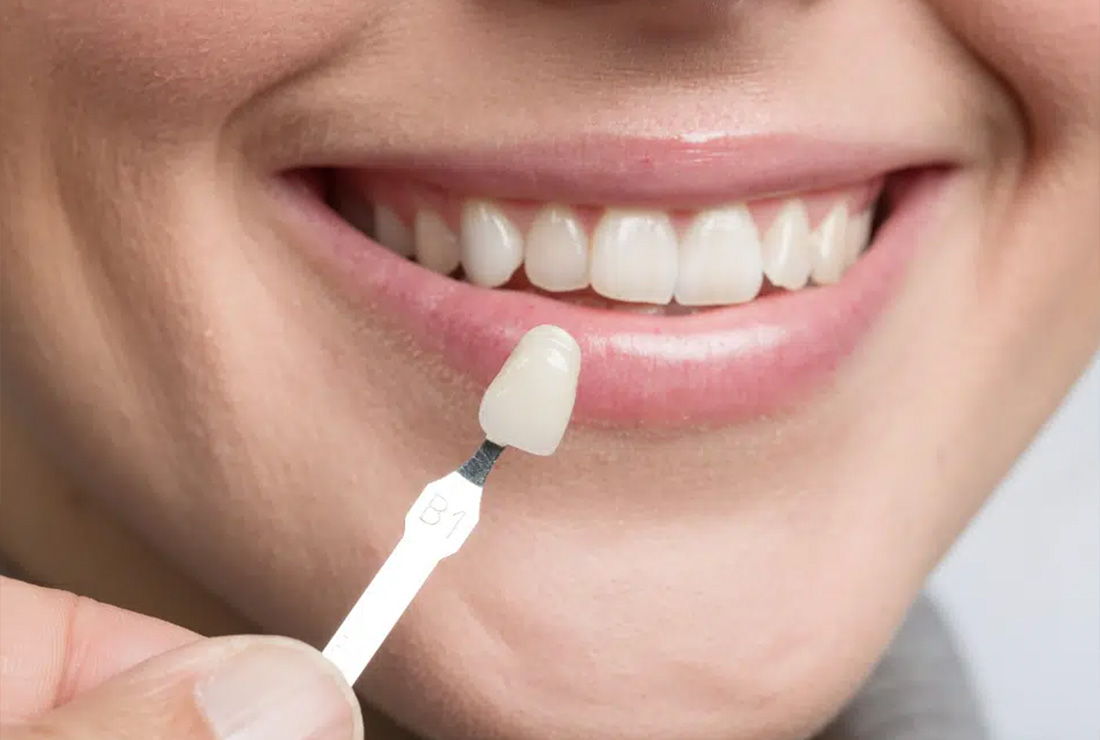 Zirconia Crowns vs. Veneers: When to Use Each Treatment